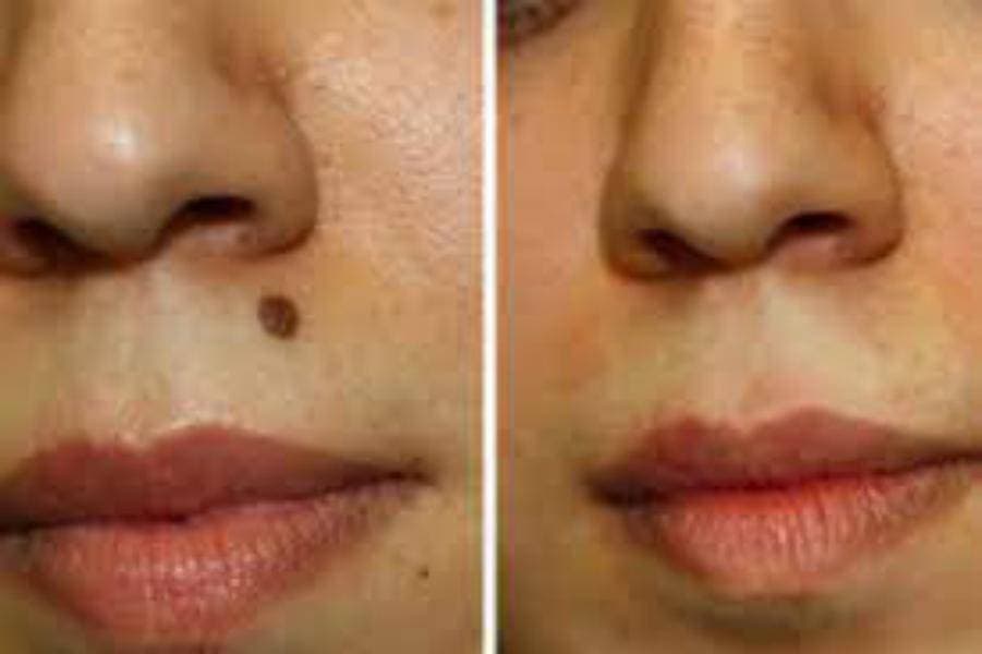 Warts Removal | Remove Warts from Face | Painless | Premium Quality