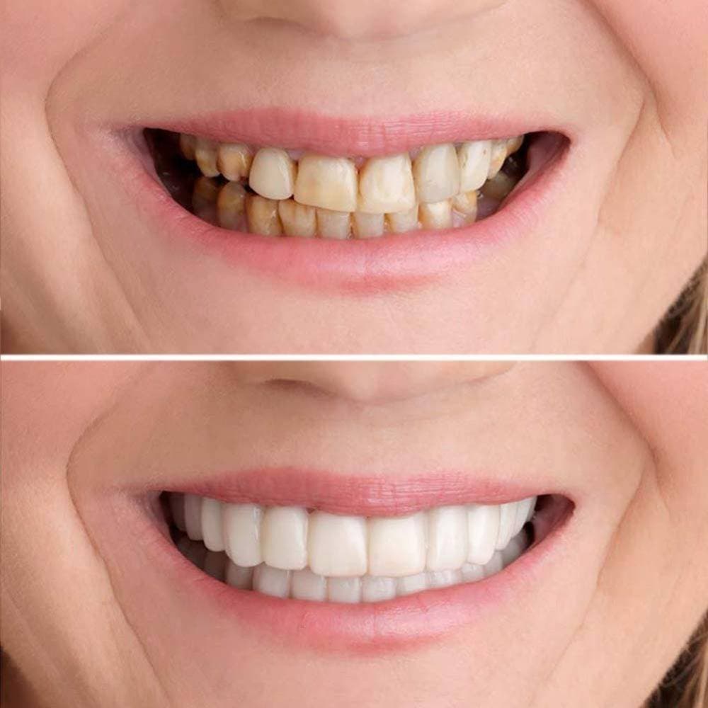 Snap On Smile Teeth Cosmetic Natural Instant Veneers Dental Fake Tooth Cover Braces Snap On Smile Teeth Whitening Denture Teeth Comfortable Veneer Teeth Veneers Whitening Snap On Smile Teeth Cosmetic Denture Instant Perfect Smile Teeth Fake Tooth