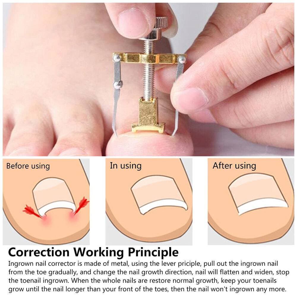 1Pc Ingrown Toe Nail Correction Pedicure Nail Tool